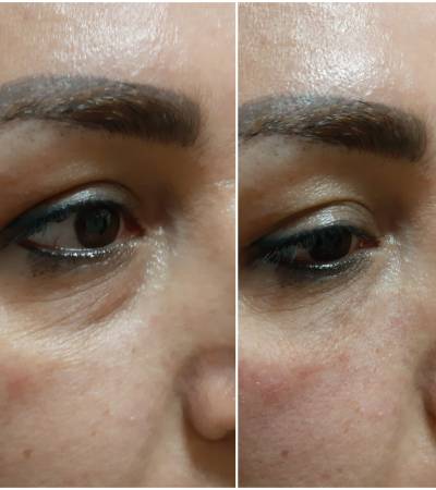 Undereye groove correction