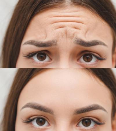 Frown lines correction