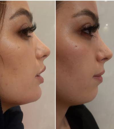 Chin correction