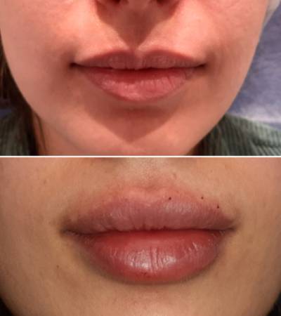 Lip augmentation