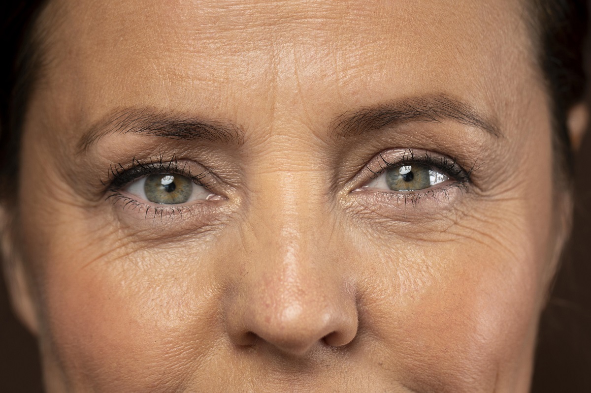 Crows feet correction