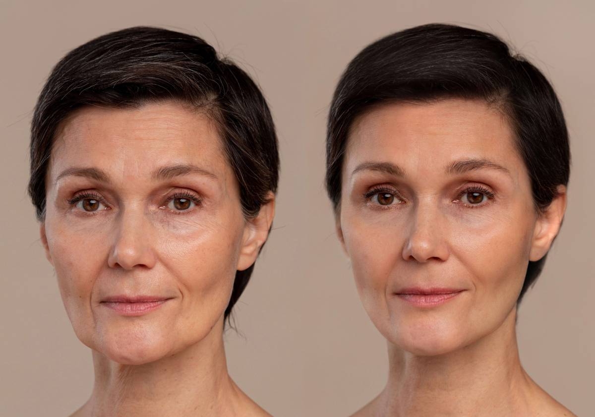 Botox for forehead wrinkle treatment Whitby