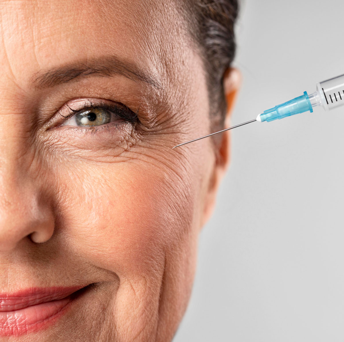 Crows Feet Correction with Botox 