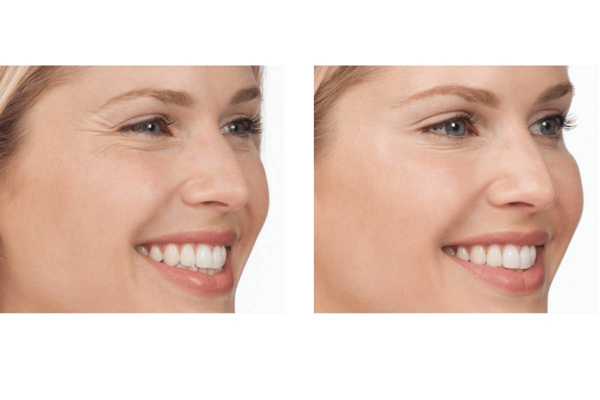 Crow’s Feet Repair with Fillers