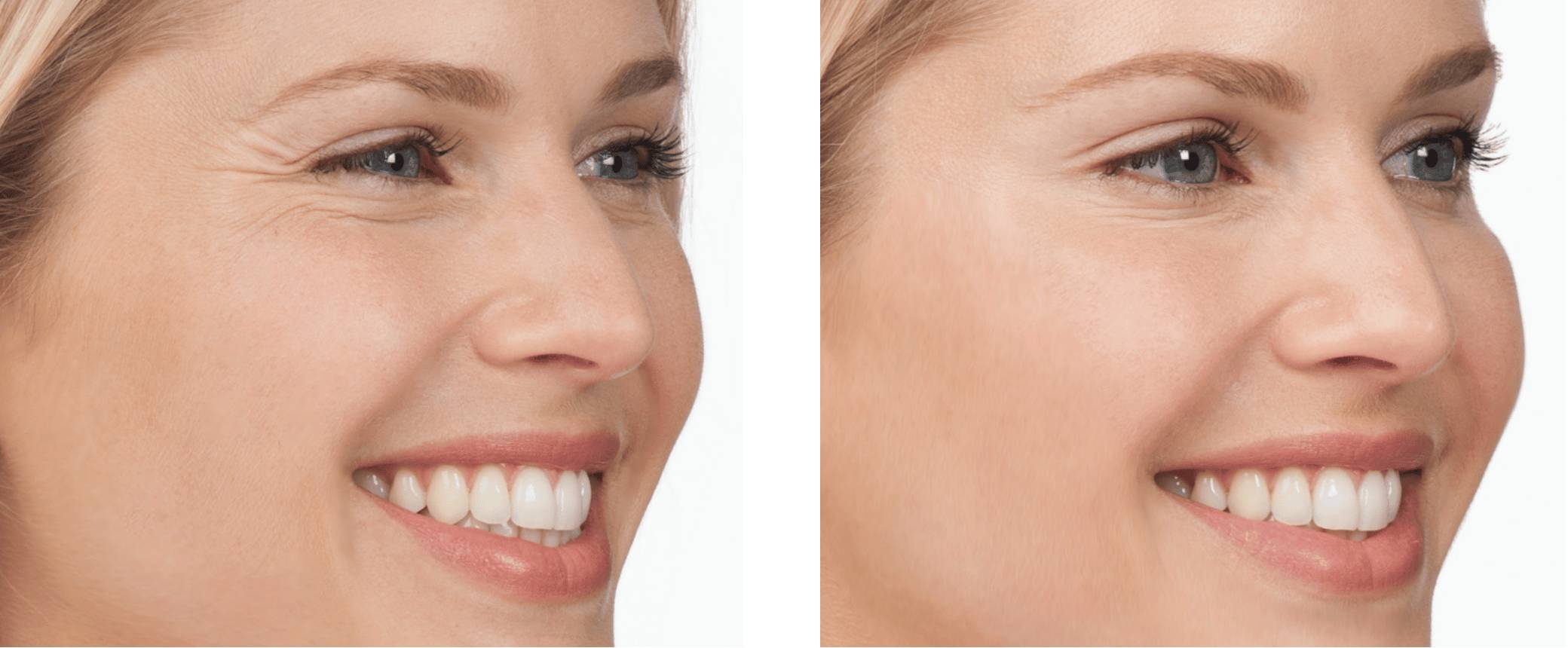 Crow’s Feet Repair with Fillers