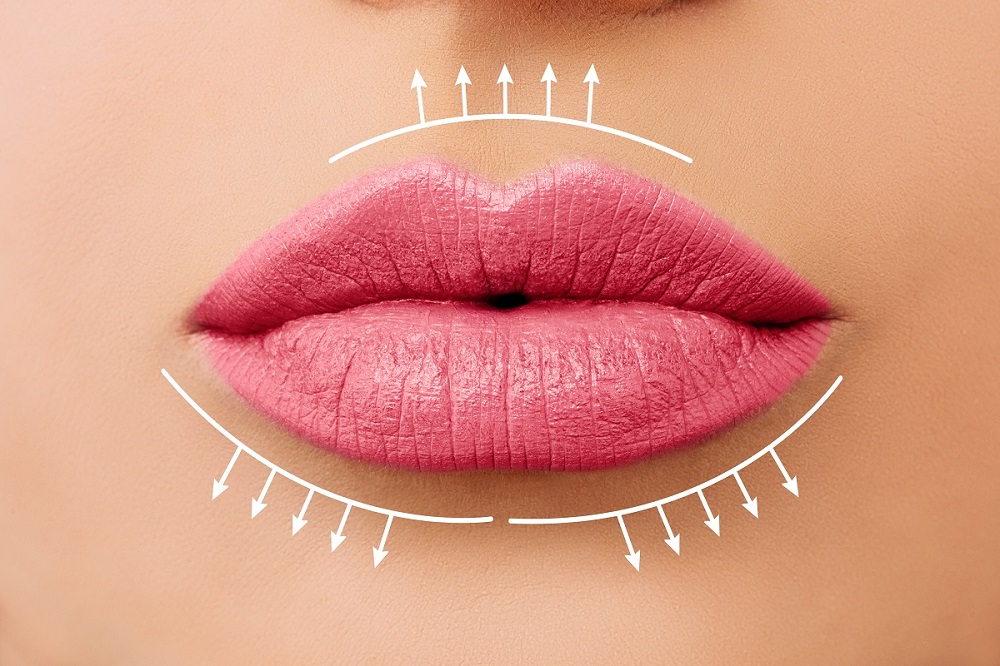 Achieve Natural-Looking Results with Lip Fillers