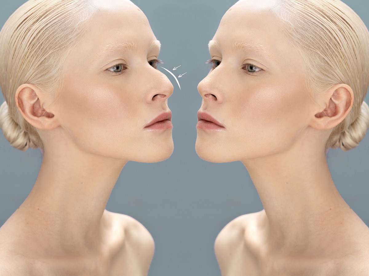 Top 5 Benefits of Non-Surgical Nose Fillers