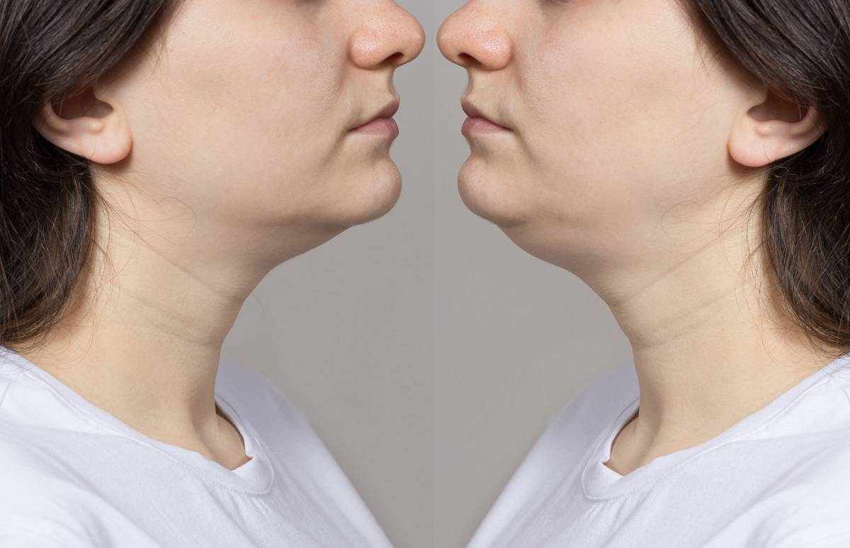 Can Fat Dissolving Injections Help You Get Rid of a Double Chin?