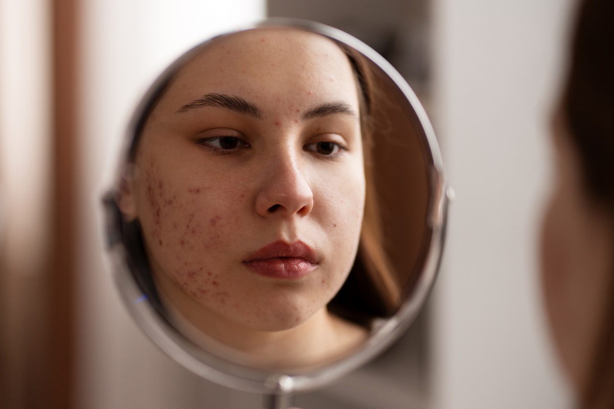 Can PRP Therapy Help with Acne Scars and Uneven Skin Tone?