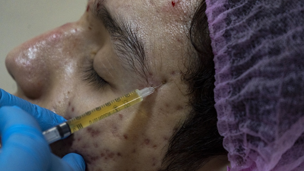 PRP Therapy