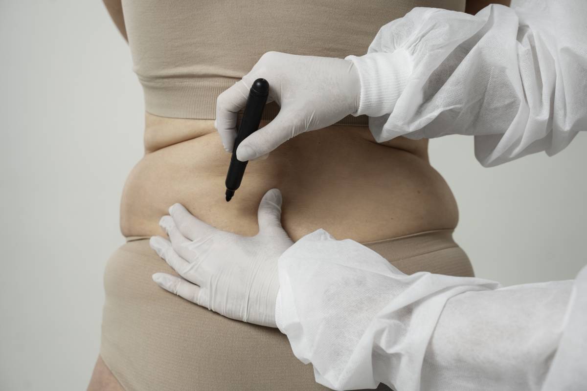 Fat Dissolving Injections offer a non-surgical solution to target and eliminate localized fat deposits,
