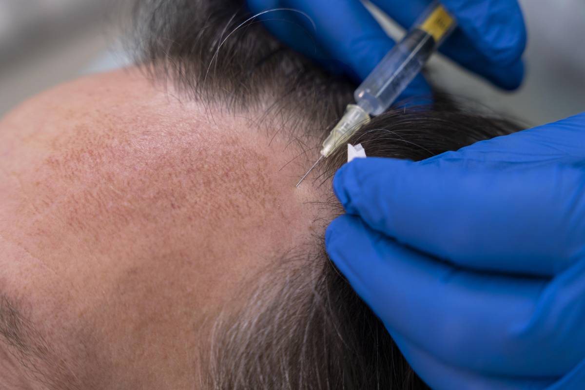What is PRP Therapy for Hair?