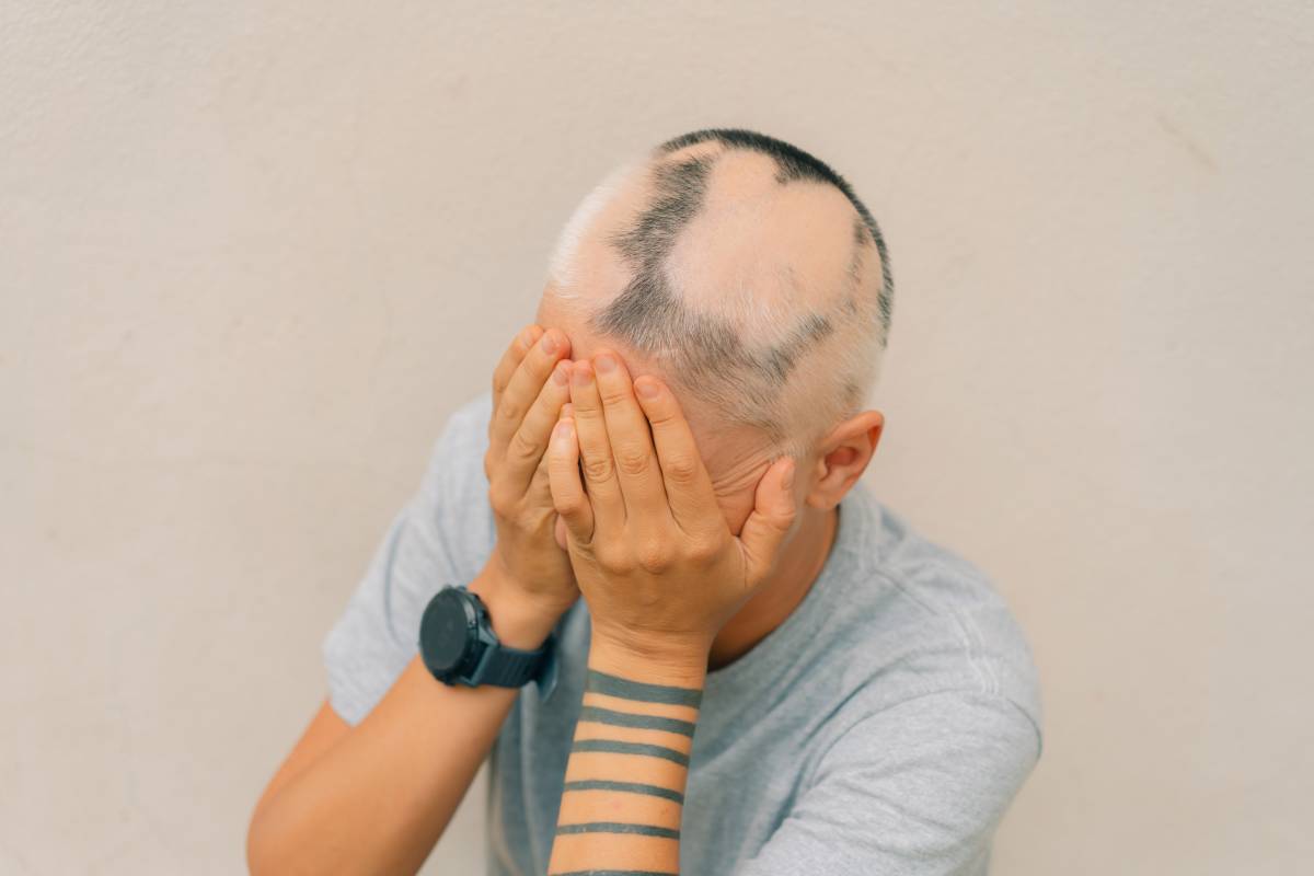 Mesotherapy for Alopecia: Does It Help with Patchy Hair Loss?