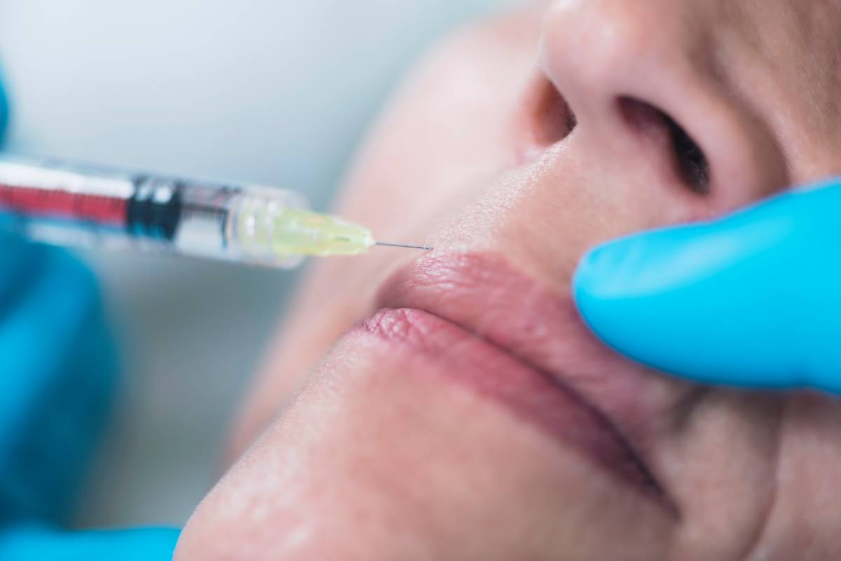 Is Botox for Smoker’s Lines Worth It?