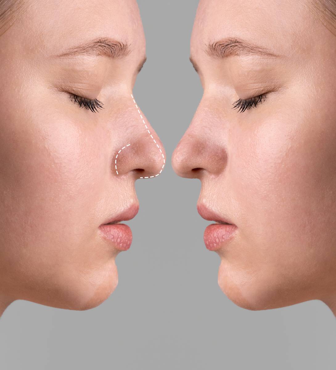Cost of Using Fillers for a Crooked Nose
