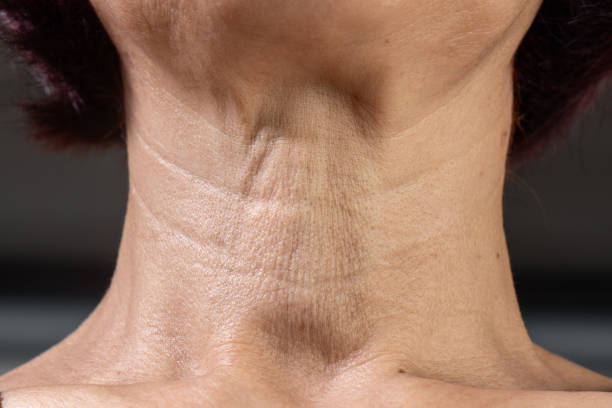 How to Treat Horizontal Lines on Your Neck Without Surgery