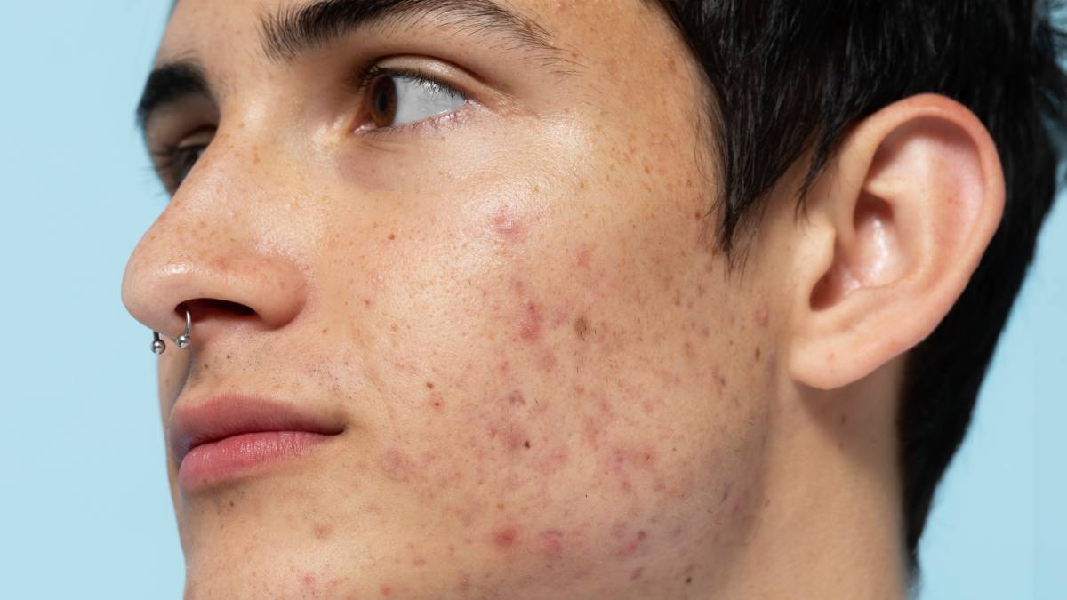 Why Combine PRP, Mesotherapy, Microneedling, and Subcision?