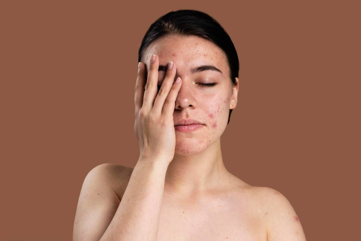 Your Complete Guide to Acne Scar Treatments