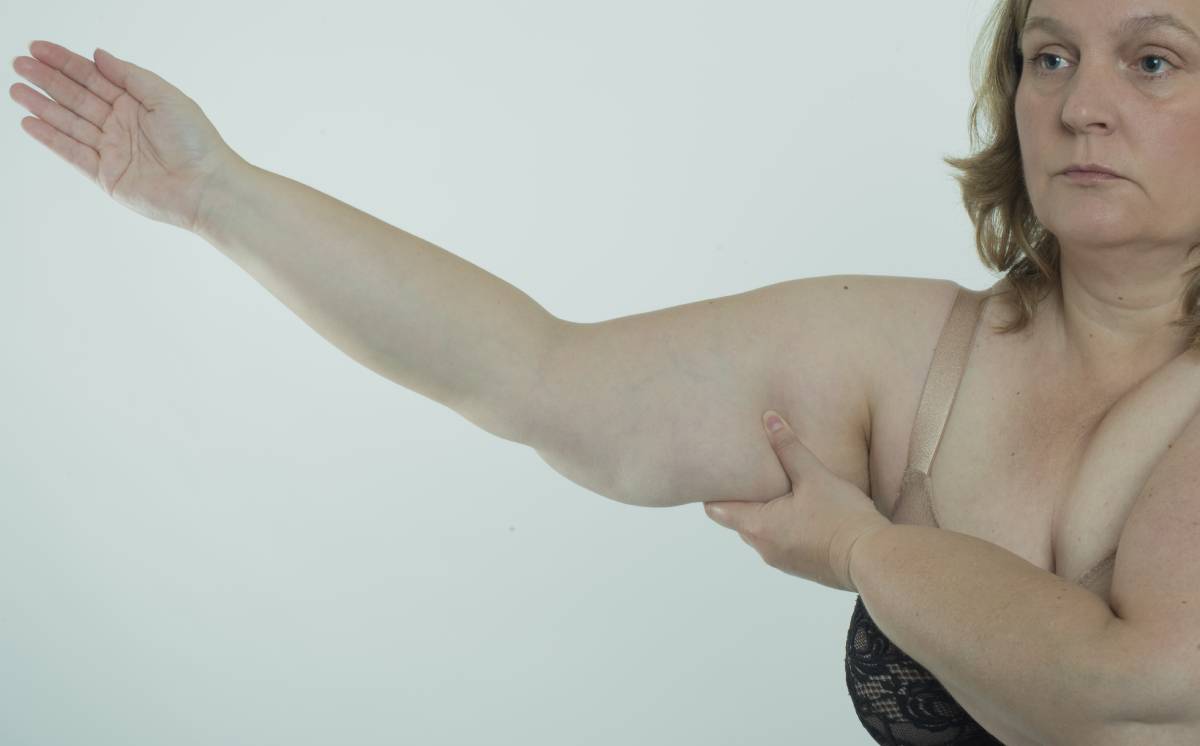 Can HIFU Tighten Loose Skin on the Arms and Abdomen?