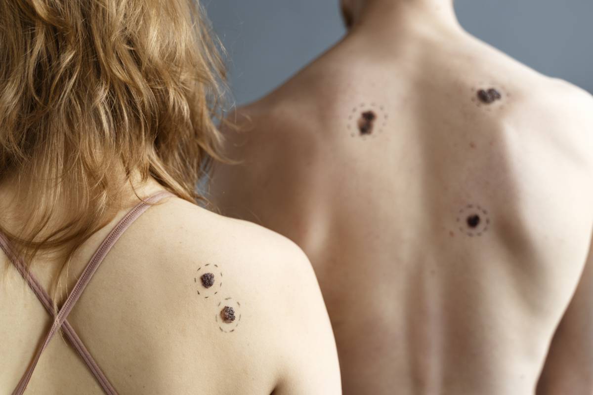 Is Your Mole Dangerous? 5 Key Signs You Should Never Ignore
