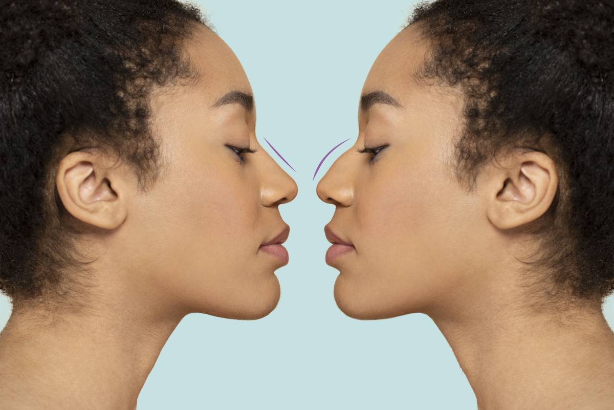 5 Common Myths About Nose Fillers—Busted by Experts
