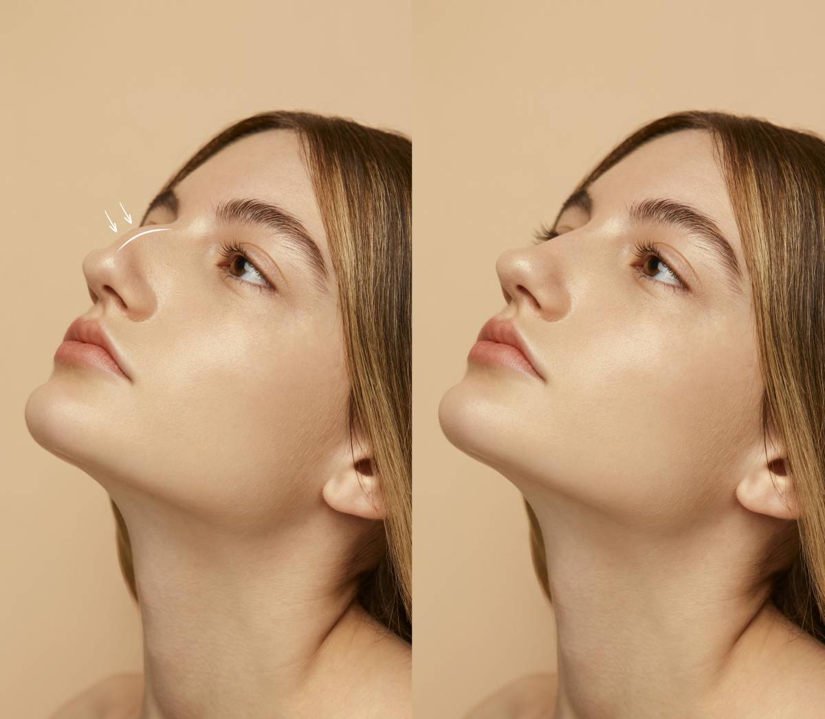 Nose Fillers Are Permanent