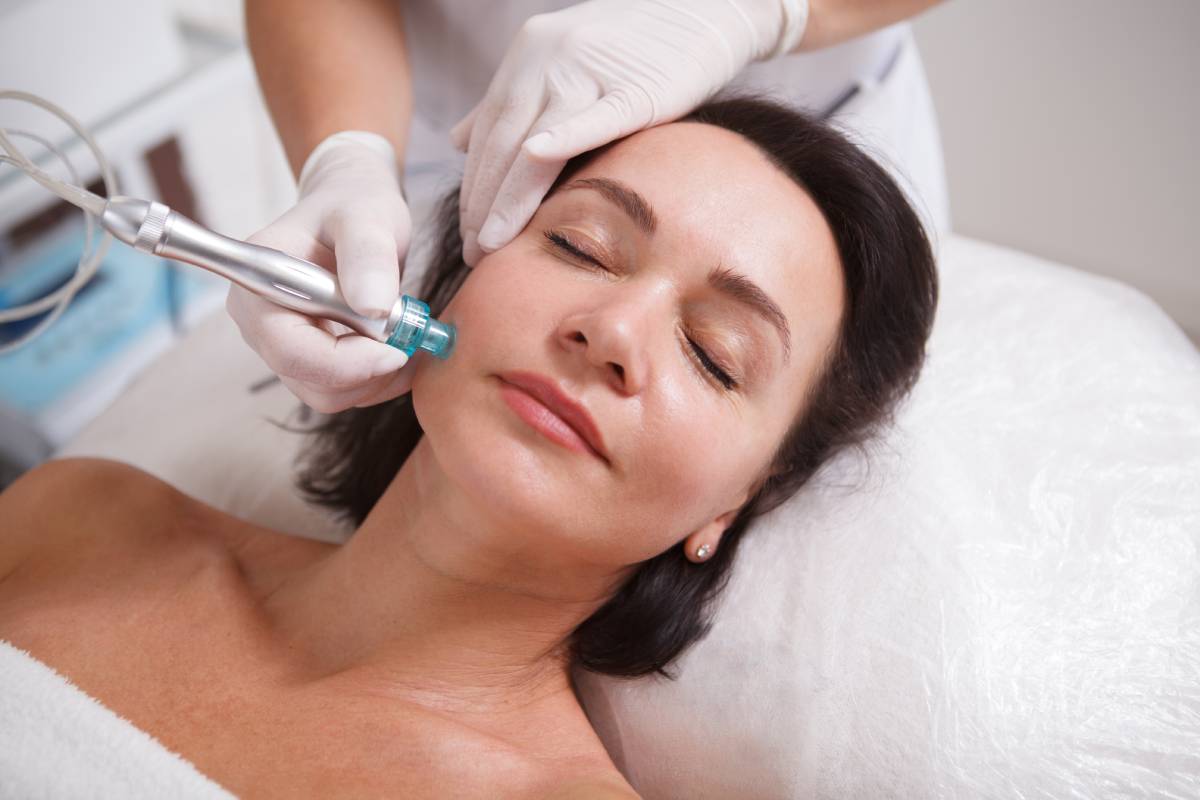 From Acne Scars to Fine Lines: Is Microneedling the Answer?