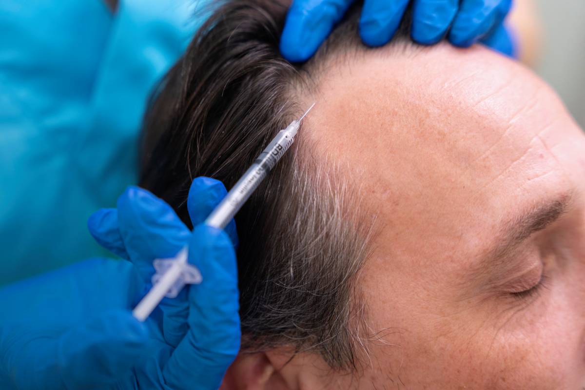 Restore Hair Loss with PRP and Mesotherapy! The Non-Surgical Solution