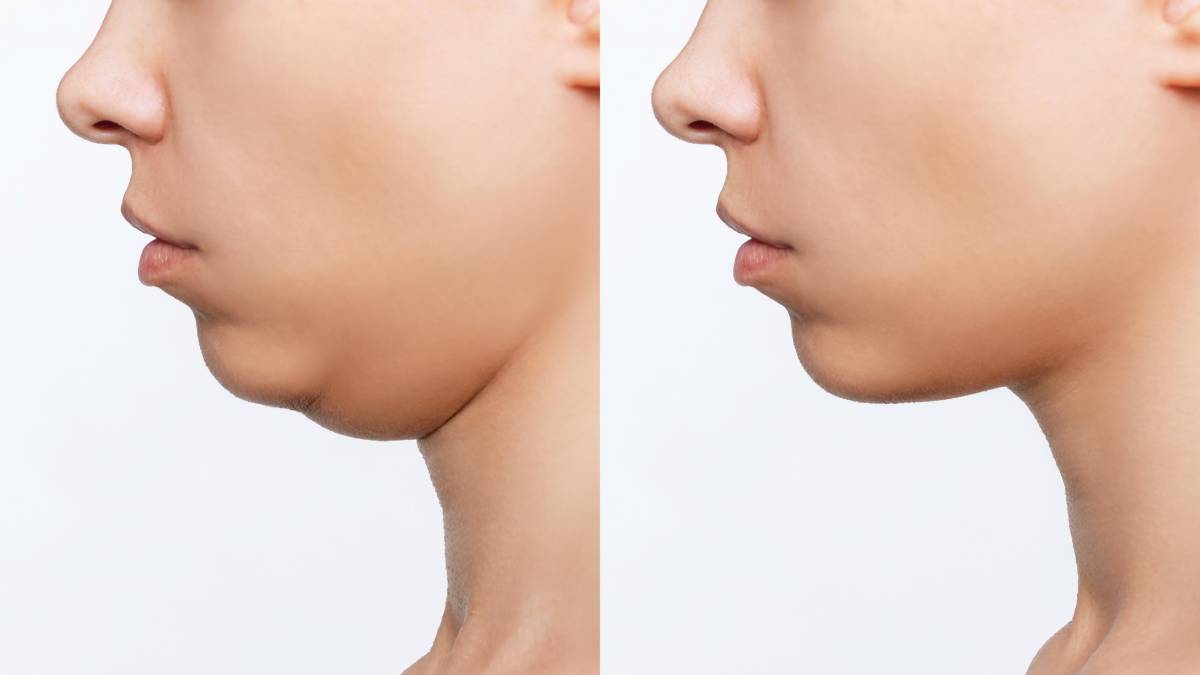 Dermal Fillers for Chin and Jawline Enhancement