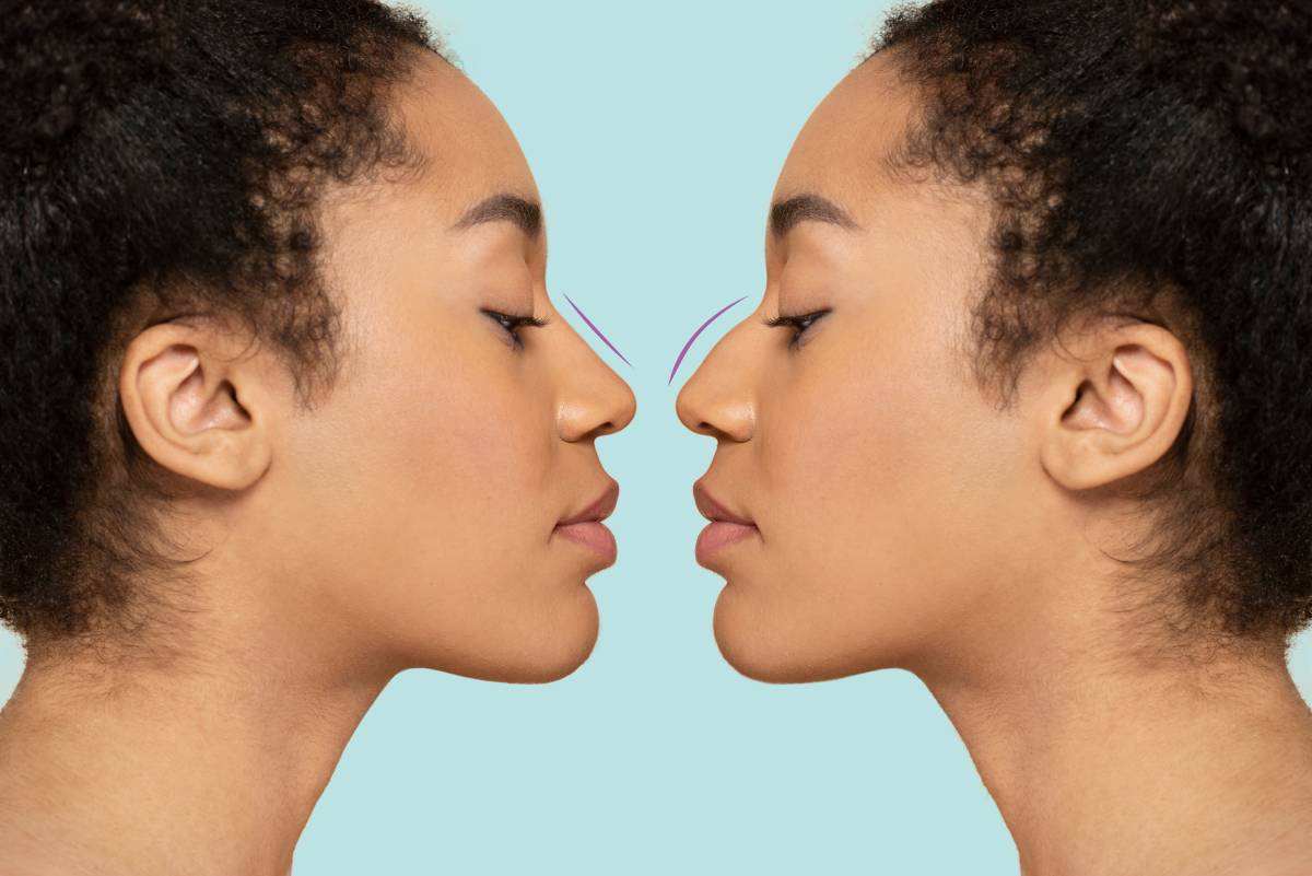 Nose Filler Treatment At Amazing New Face