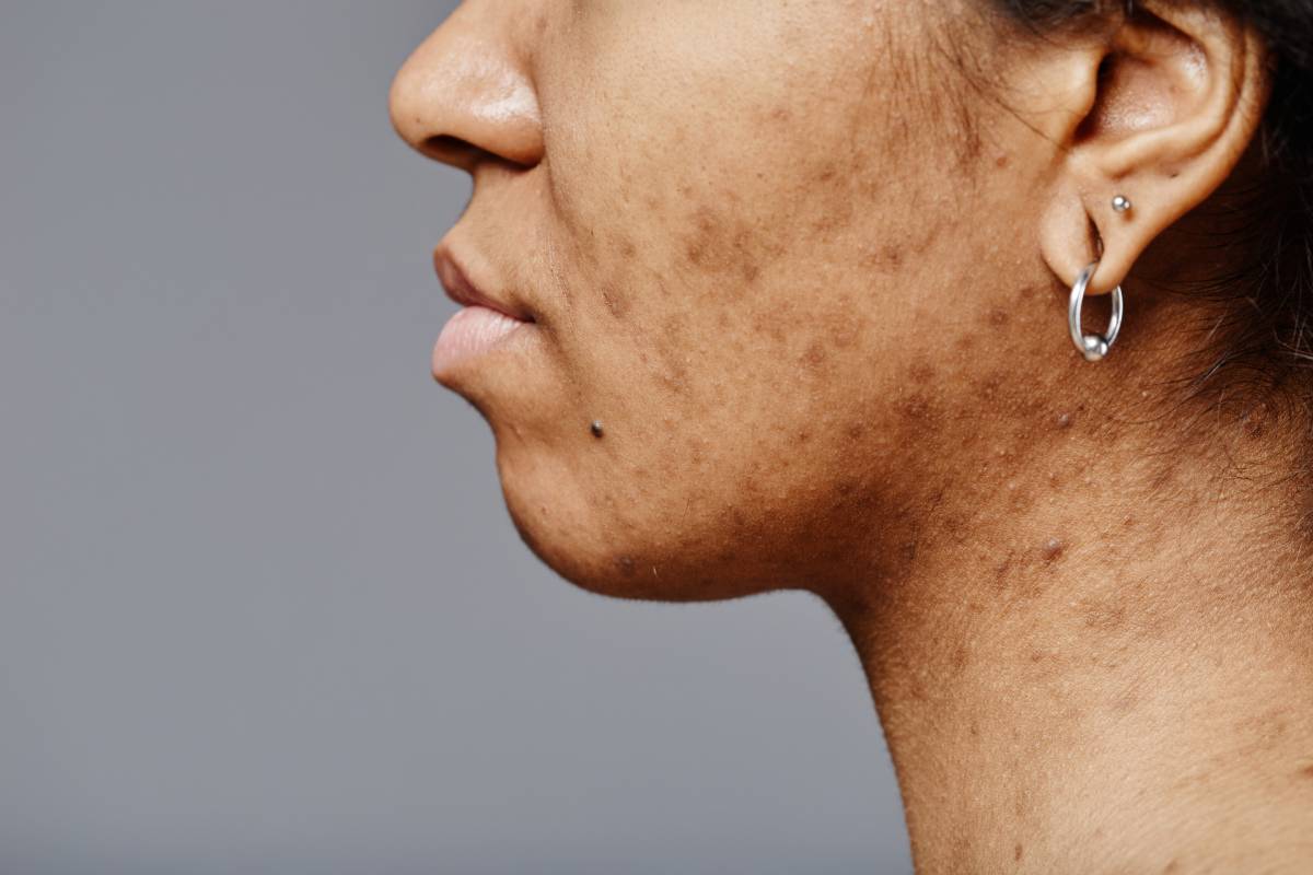 RF Microneedling for Acne Scars: Is It Really Effective or Just Advertising?