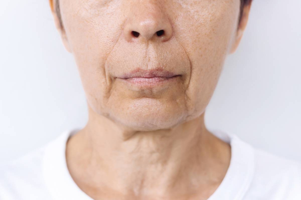 How Long Do Marionette Line Fillers Last?