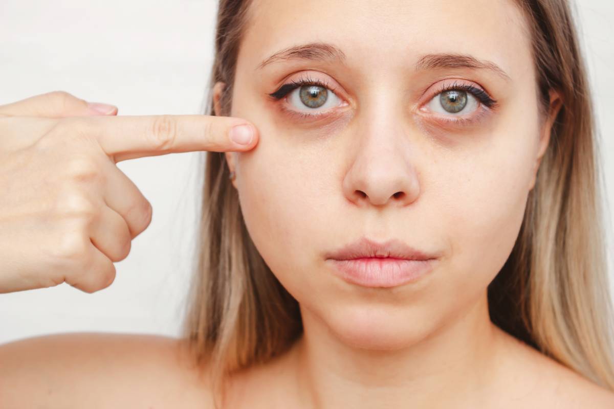 PRP for Dark Circles and Puffiness Under the Eyes: Does It Really Work?