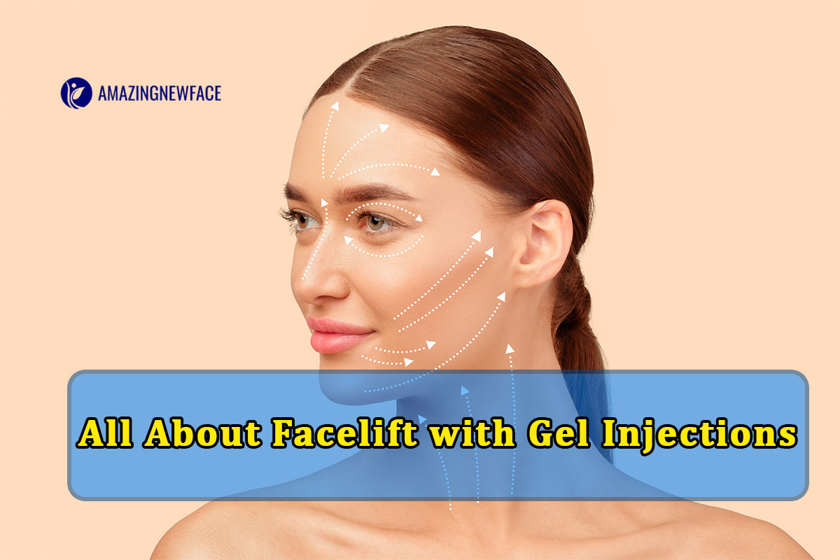 All About Facelift with Gel Injections