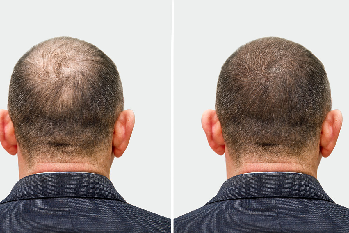 Before and Aftercare for PRP Hair Treatment