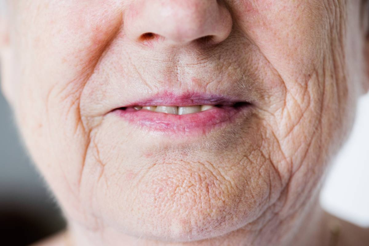 Cost of Wrinkle‑Reducing Injections Around the Lips