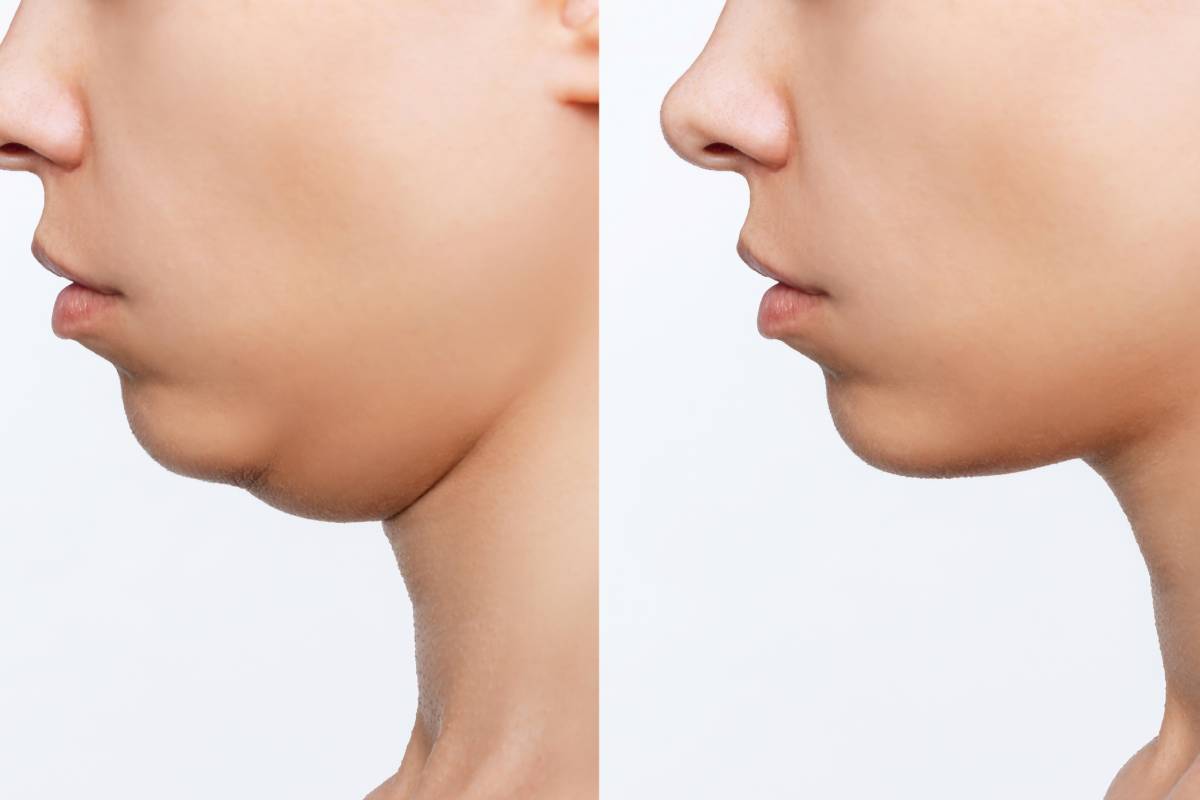 Non-Surgical Medical Options for Losing a Double Chin
