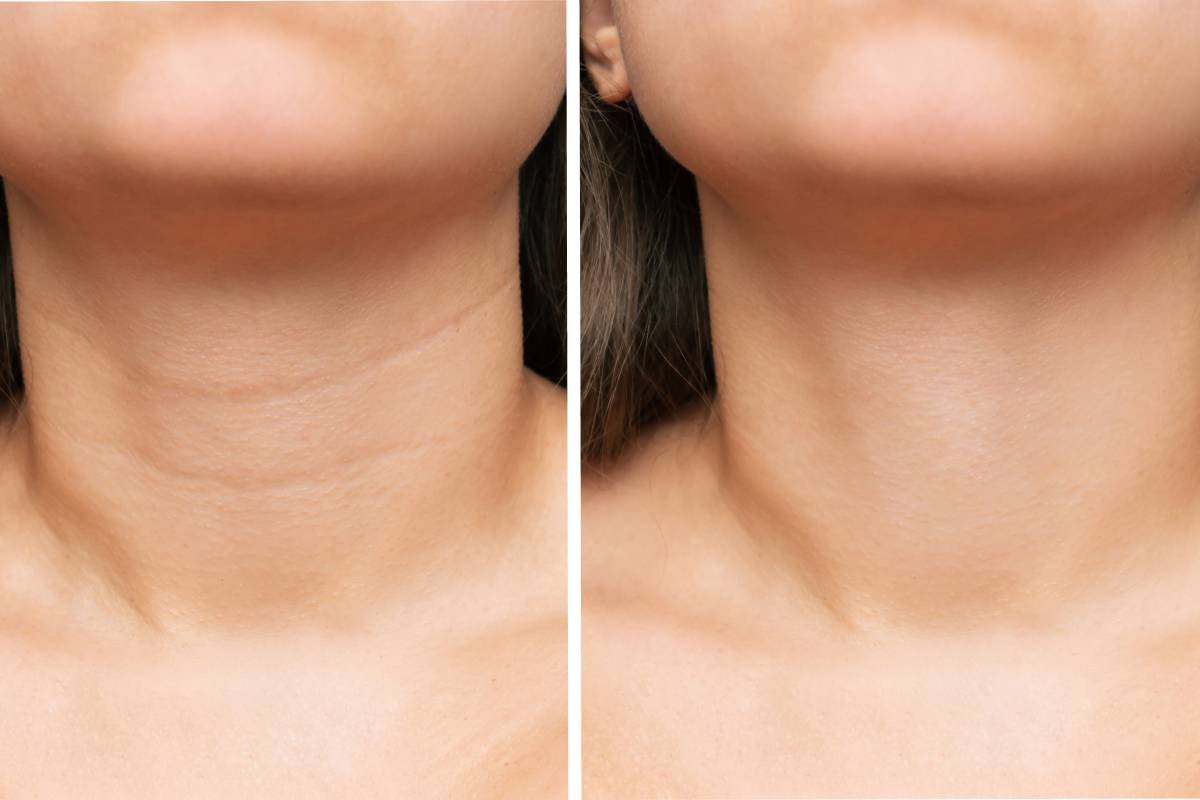 Neck and décolleté rejuvenation