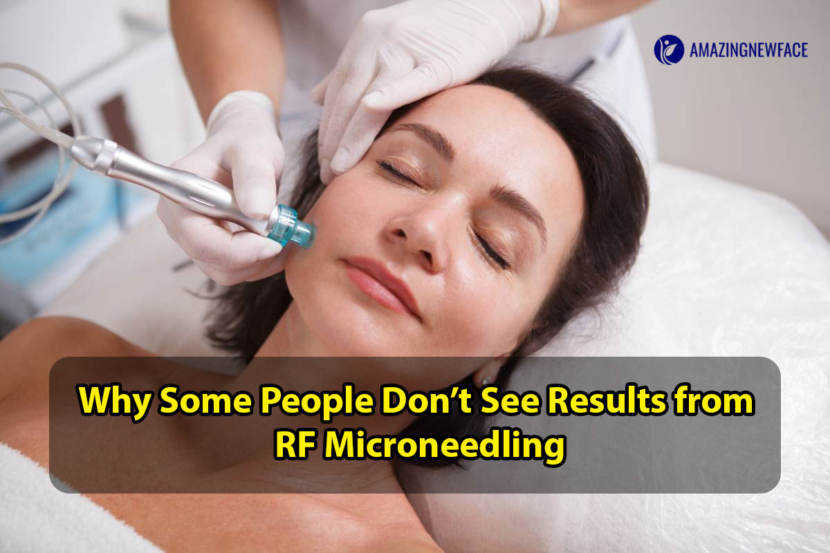 Why Some People Don’t See Results from RF Microneedling