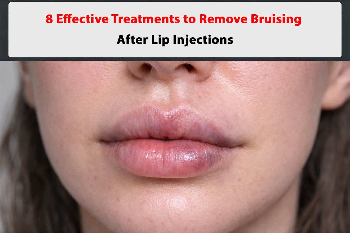 8 Effective Treatments to Remove Bruising After Lip Injections