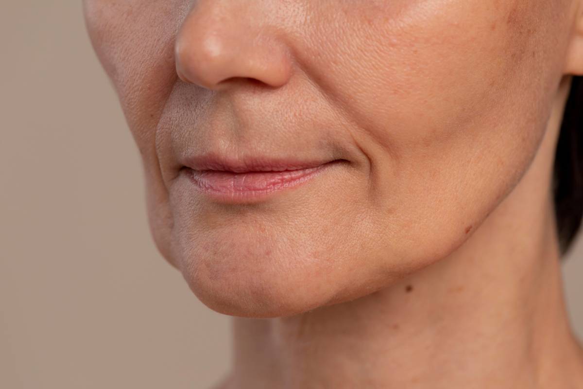 HIFU vs RF Microneedling for Jawline Tightening