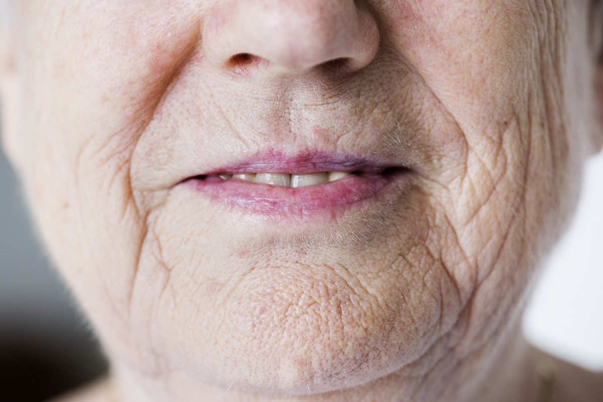 Does Botox Remove Smoker Lines Completely?