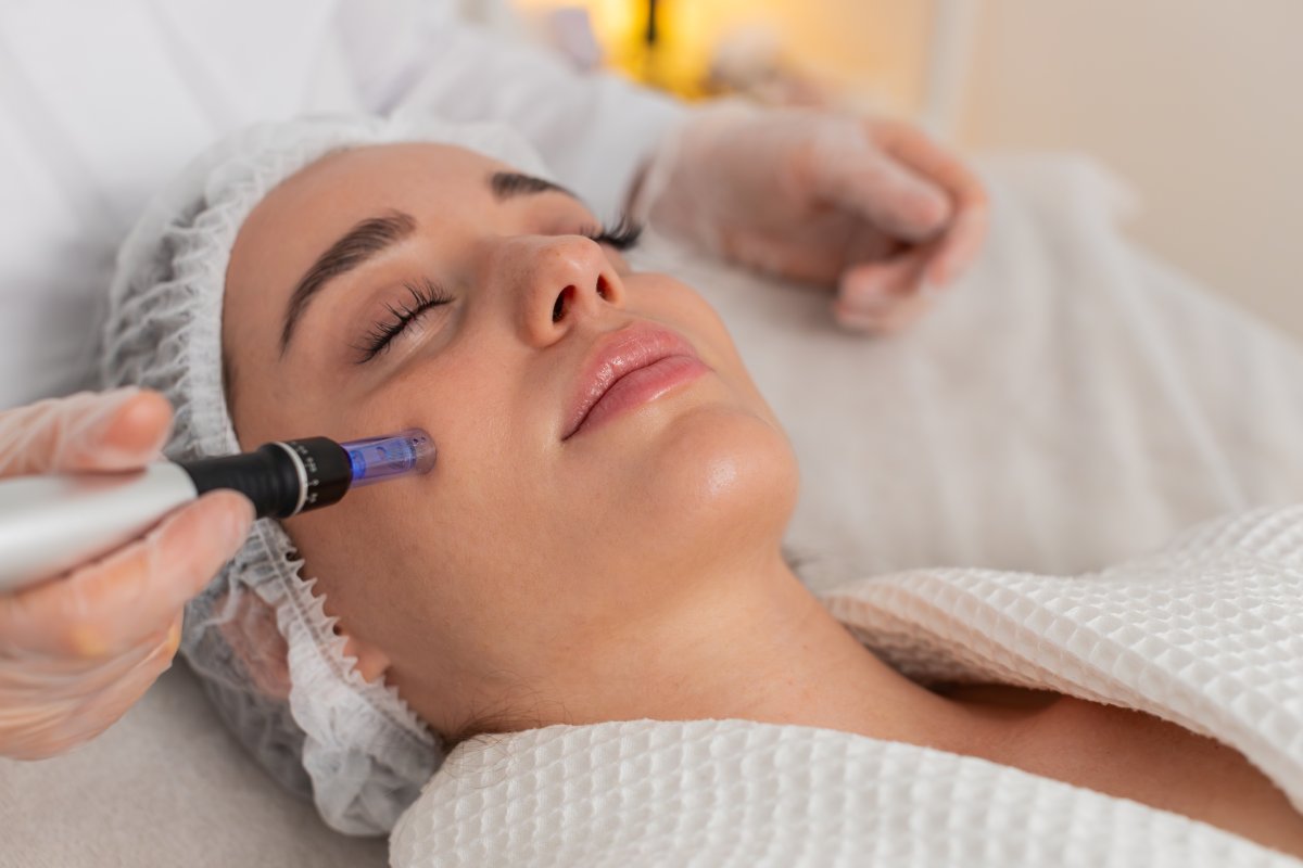 RF Microneedling on the cheek