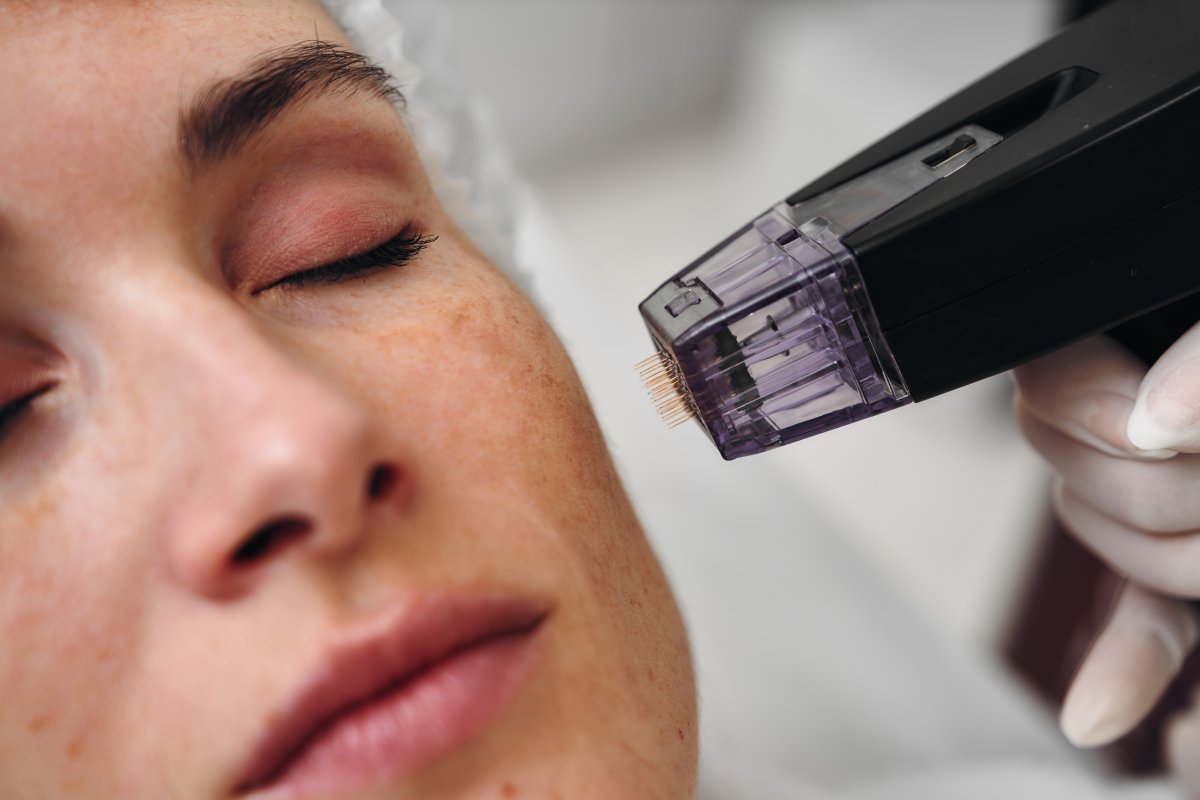 When Should You Postpone RF Microneedling? When Should You Postpone RF Microneedling?