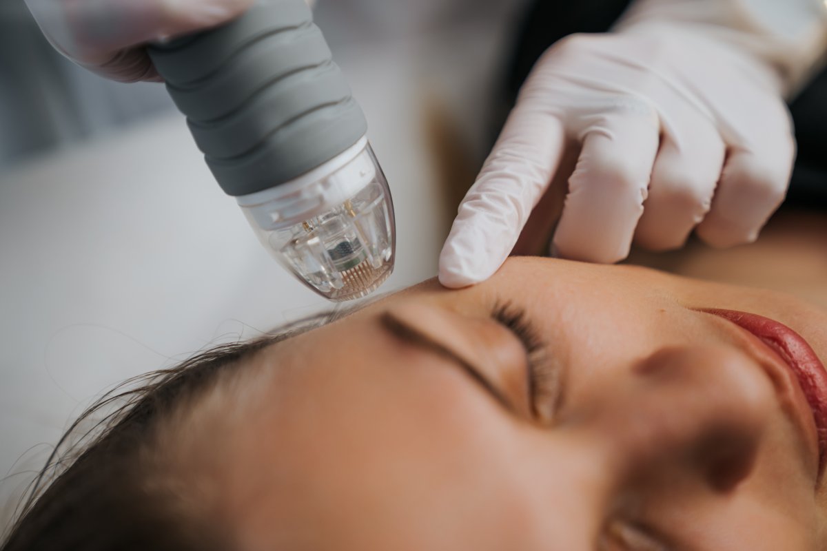Who Should Avoid RF Microneedling?