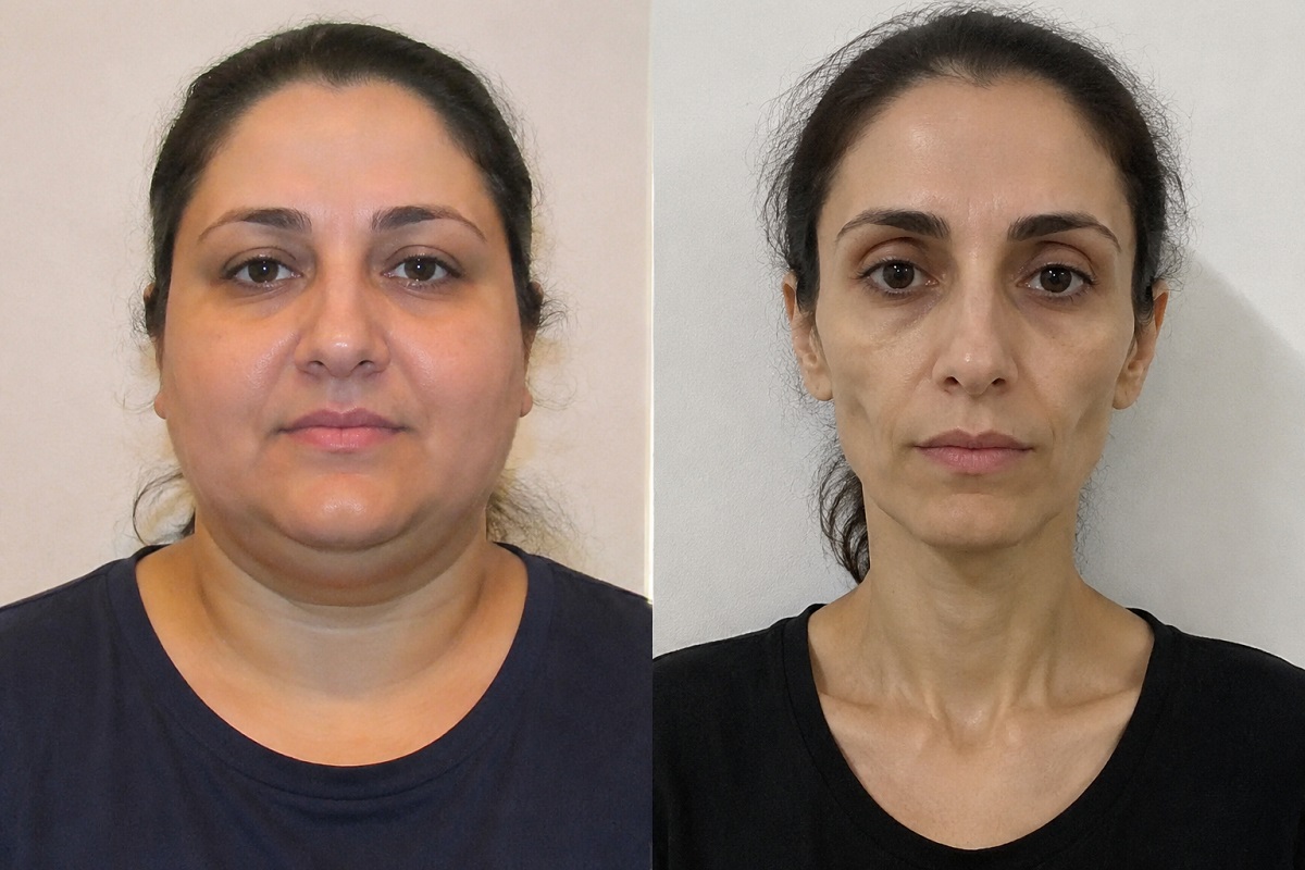 What Is “Ozempic Face,” and Which Treatments Actually Address It?