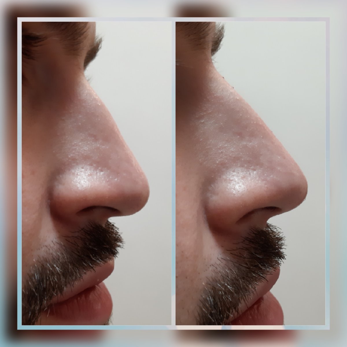 nose filler in Thornhill amazing new face nose filler in Thornhill amazing new face