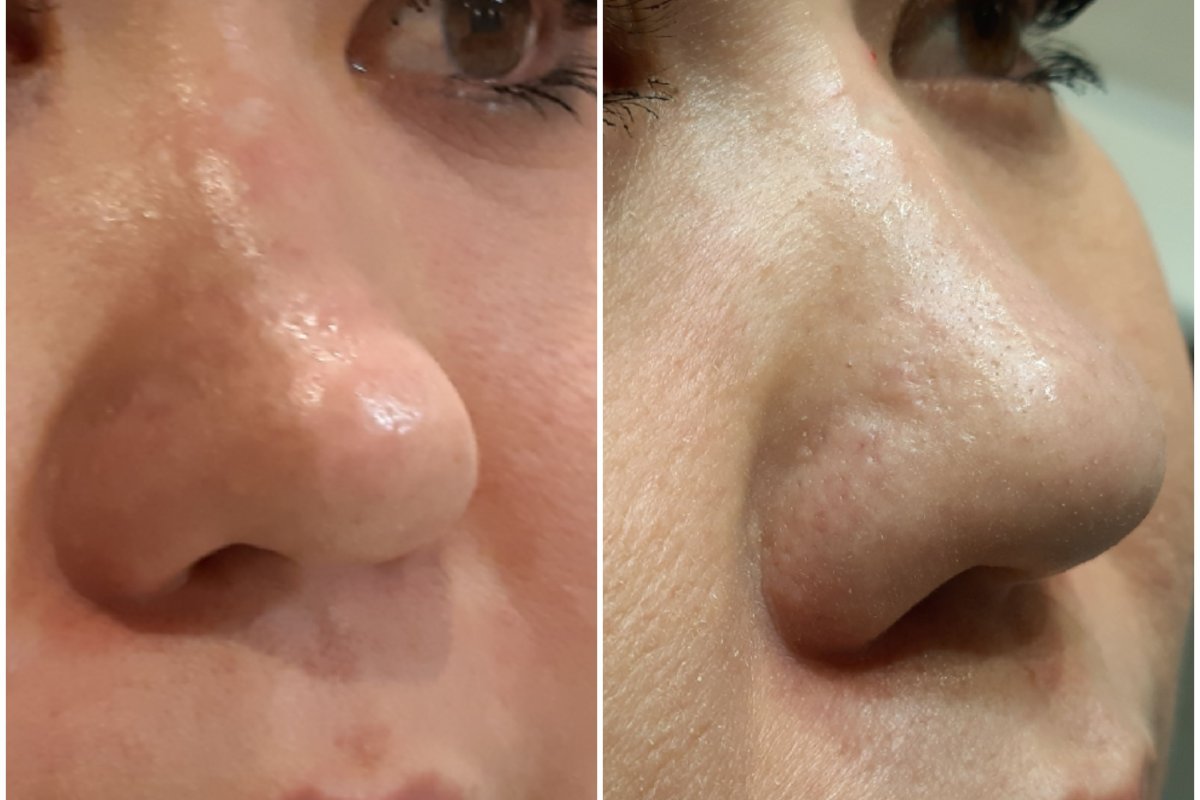 Nose Filler in Thornhill: What to Know Before Your First Appointment