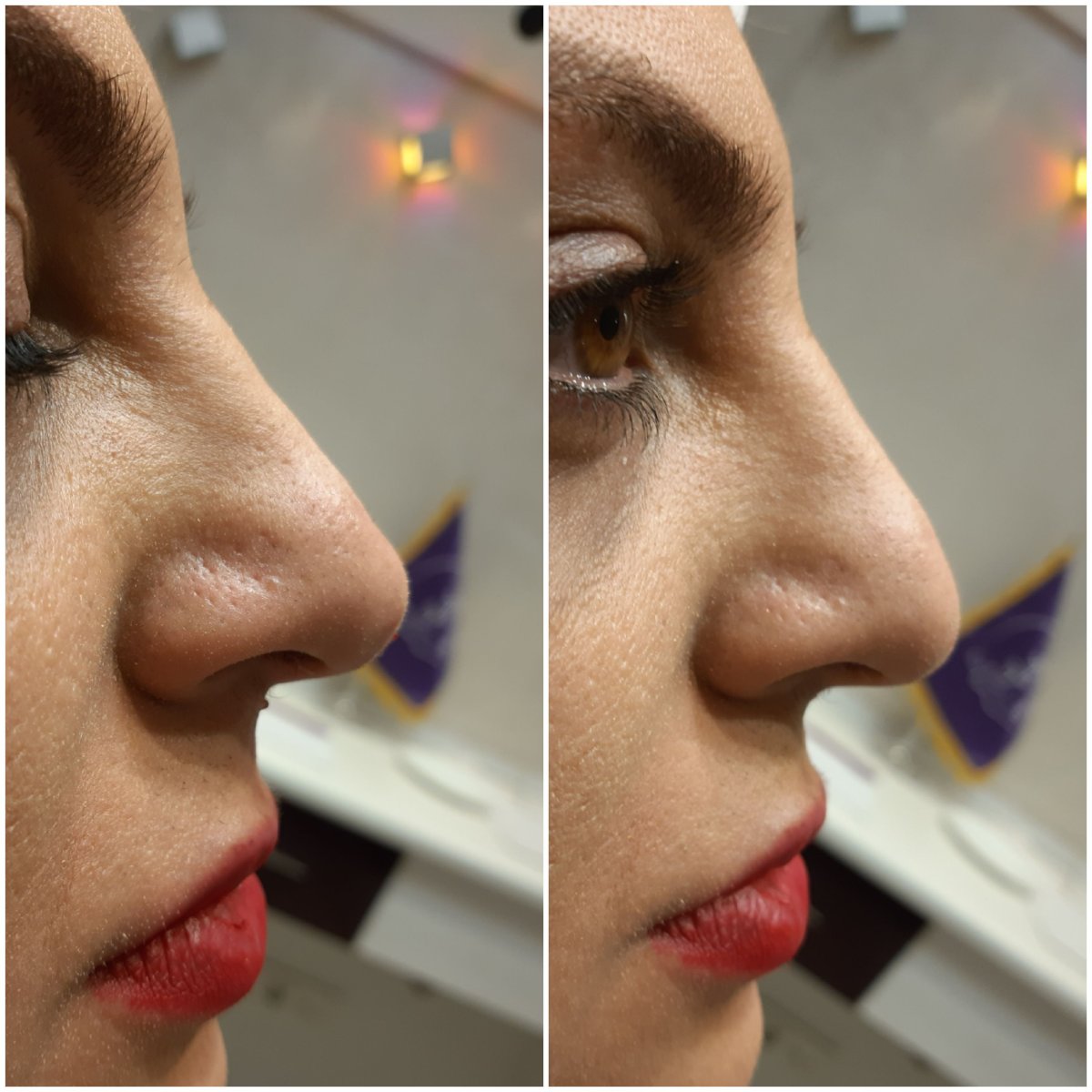 nose filler treatment at amazing new face nose filler treatment at amazing new face