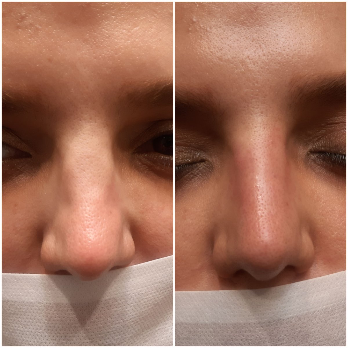 What Nose Filler Cannot Fix